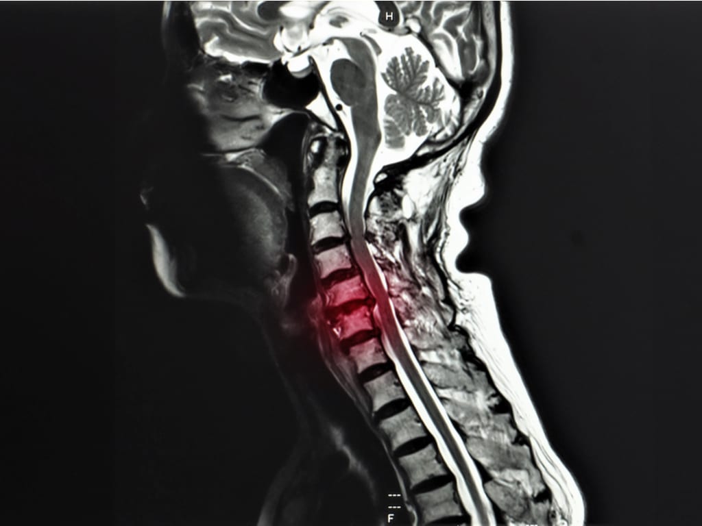Поражение межпозвоночного шейного отдела с радикулопатией
